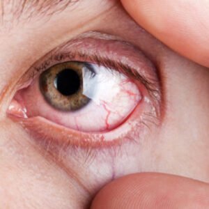 Toxoplasmose