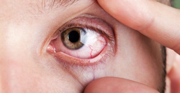 Toxoplasmose