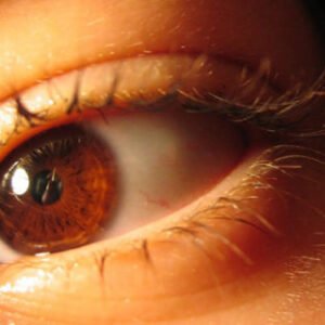 Retinopatia Diabética