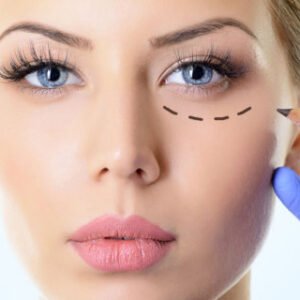 Blefaroplastia