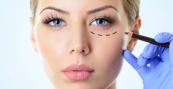 Blefaroplastia