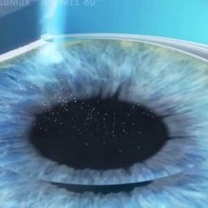 Dúvidas sobre Cirurgia Refrativa