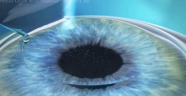 Dúvidas sobre Cirurgia Refrativa