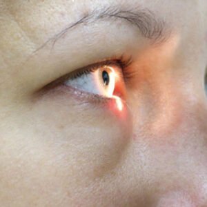 Iridectomia por YAG laser