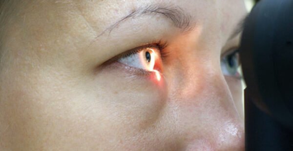 Iridectomia por YAG laser